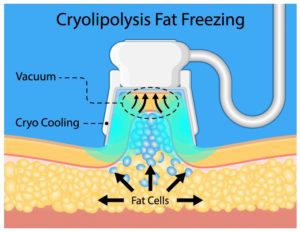 Nurse Kelly | CoolSculpting