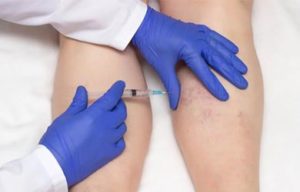 Nurse Kelly | Sclerotherapy